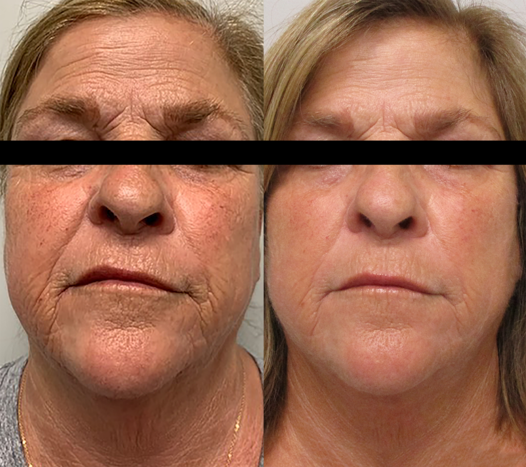Before and after comparison of facial rejuvenation treatment, showcasing significant reduction in wrinkles and improved skin texture. The left image displays visible signs of aging, while the right image highlights smoother skin and a more youthful appearance.