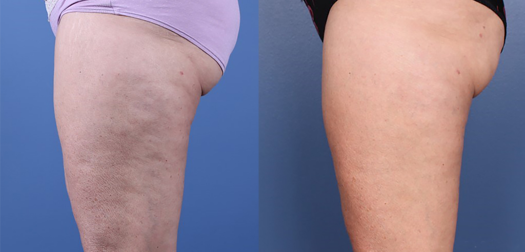 Before and after image showcasing the transformation of a thigh, highlighting the reduction of cellulite and skin texture improvement. The left side displays visible cellulite, while the right side shows smoother skin, emphasizing effective body contouring treatment results.