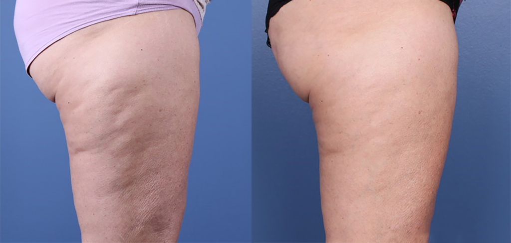 Before and after comparison of thigh skin texture showing reduction in cellulite appearance. The left thigh displays noticeable dimpling and uneven texture, while the right thigh appears smoother and firmer. Background is a solid blue color.