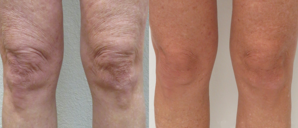 Before and after comparison of knees showing significant differences in skin texture and appearance, highlighting improvements in skin condition and elasticity. The left knee appears wrinkled and sagging, while the right knee shows smoother, firmer skin.