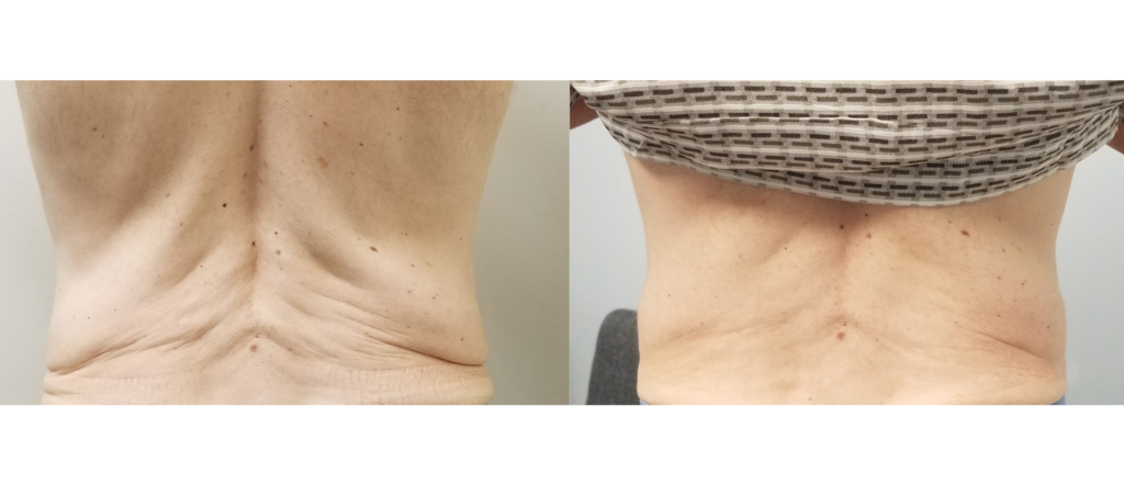 Before and after images showing skin texture and appearance on the lower back, highlighting improvements in skin elasticity and smoothness. The left side displays a more wrinkled texture, while the right side shows a firmer, more toned look after treatment.
