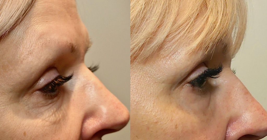 Before and after comparison of an eye area showing noticeable reduction in wrinkles and fine lines, highlighting the effectiveness of cosmetic treatments. The left side displays more pronounced aging signs, while the right side shows smoother, rejuvenated skin with enhanced eyelash appearance.