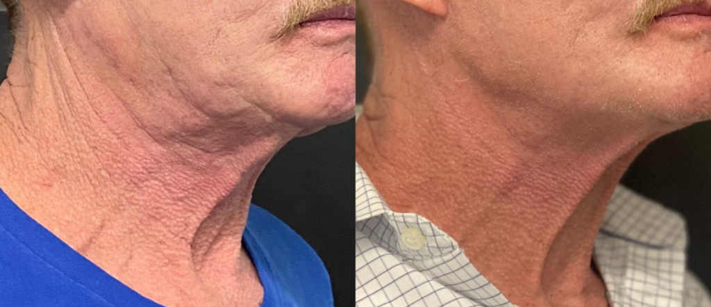 Before and after images showcasing the neck area of a man, highlighting improvements in skin texture and appearance. The left side shows visible signs of aging, including wrinkles and sagging skin, while the right side displays a smoother, firmer neck with reduced signs of aging.