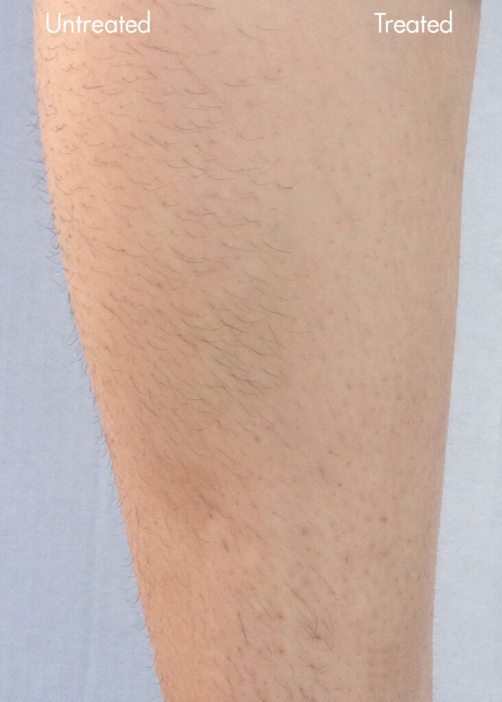 Comparison of untreated and treated skin, showing hair reduction and smoother texture on the treated side.