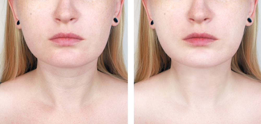 Nefertiti Lift Treatment – What Is It?