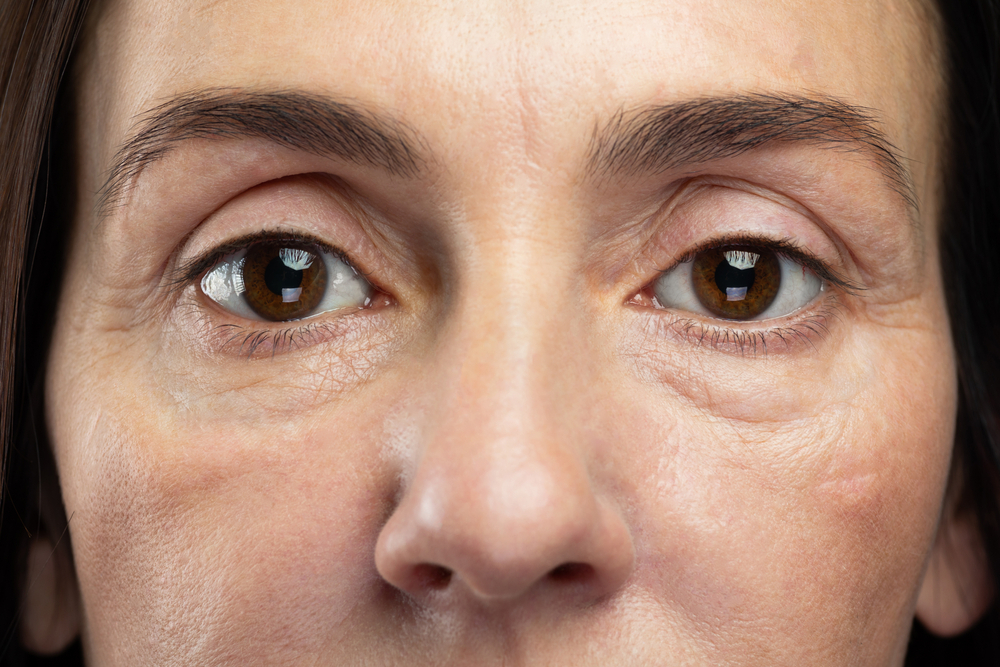 How To Remove Bags Under Eyes