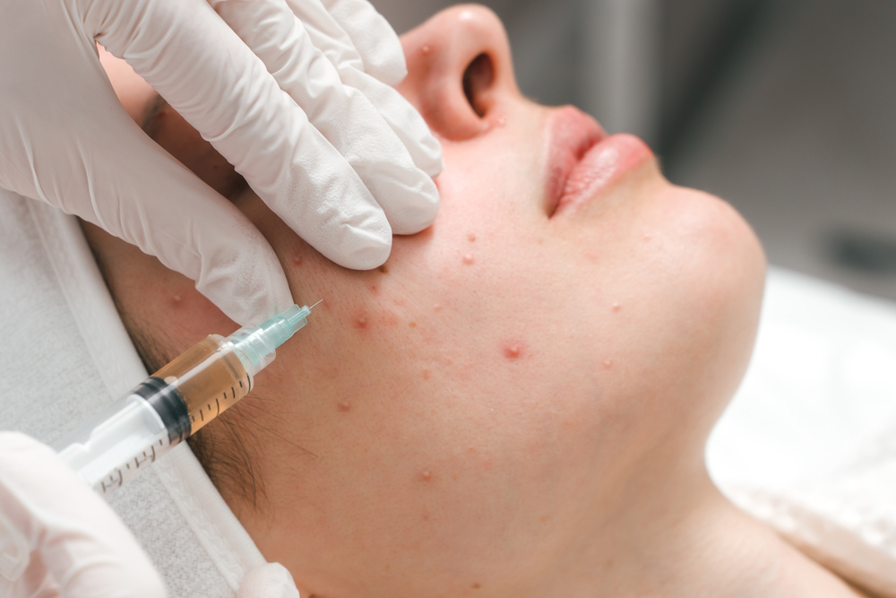 A dermatologist performing a facial injection treatment on a patient with acne, showcasing the use of a syringe for skin rejuvenation or acne scar reduction.