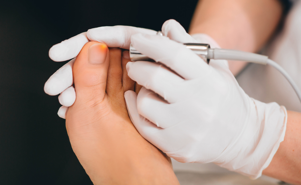 How To Treat Fungal Nail