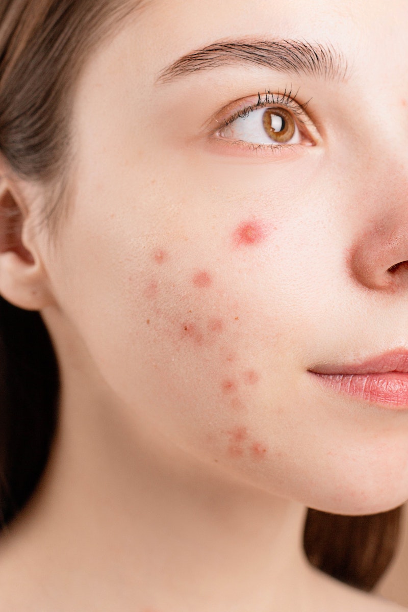 Will Cystic Acne Ever Go Away?