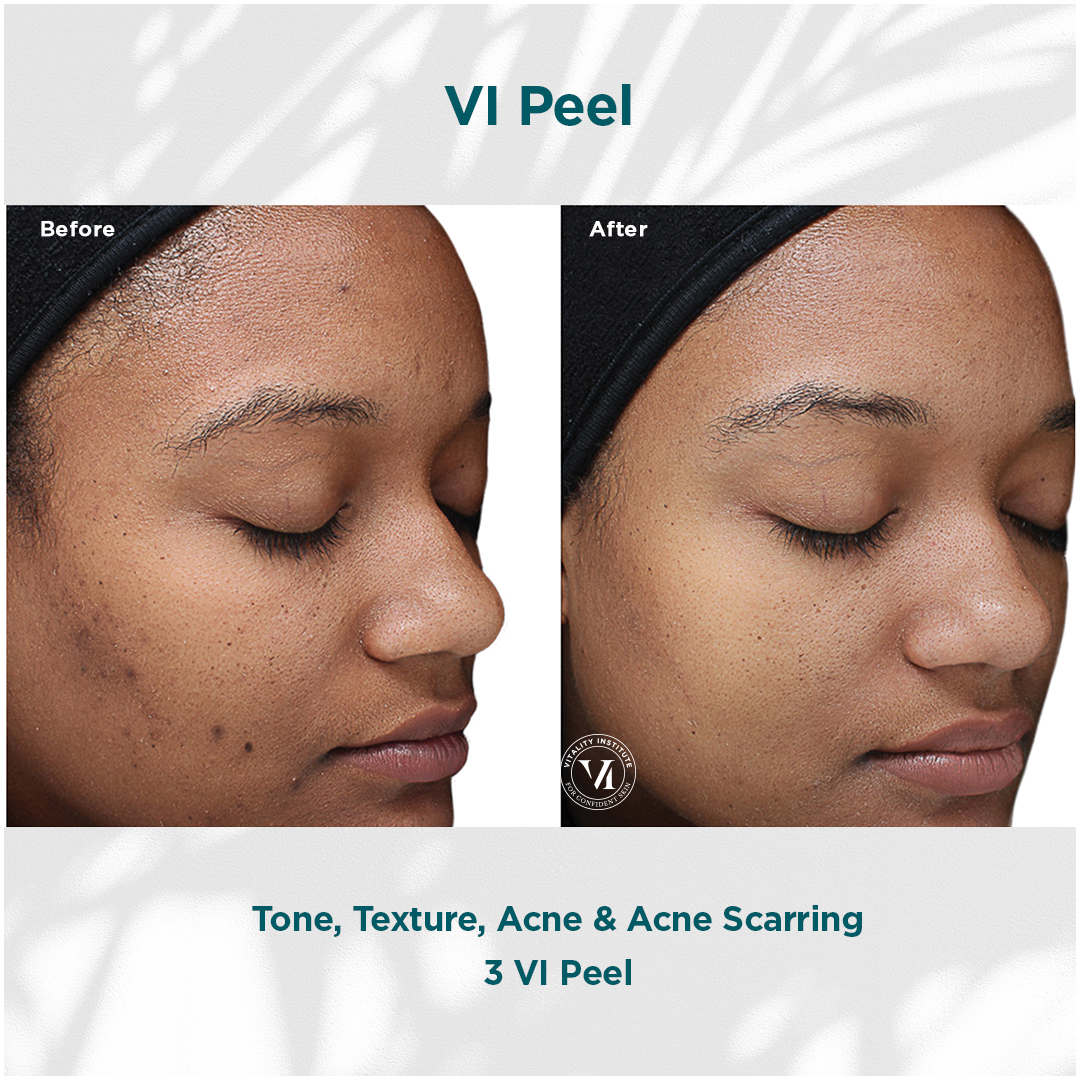 Before and after images showcasing the results of a VI Peel on a woman's skin, highlighting improvements in tone, texture, acne, and acne scarring after three treatments.