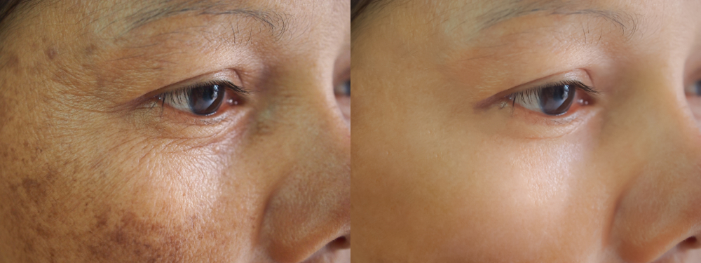 Can Melasma Go Away?