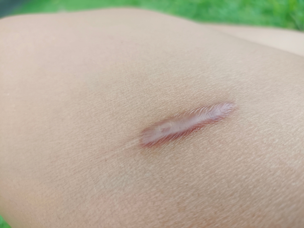 Close-up of a healing scar on light skin, showcasing its texture and color against a blurred green background. The scar appears slightly raised and pinkish, indicating recent healing.
