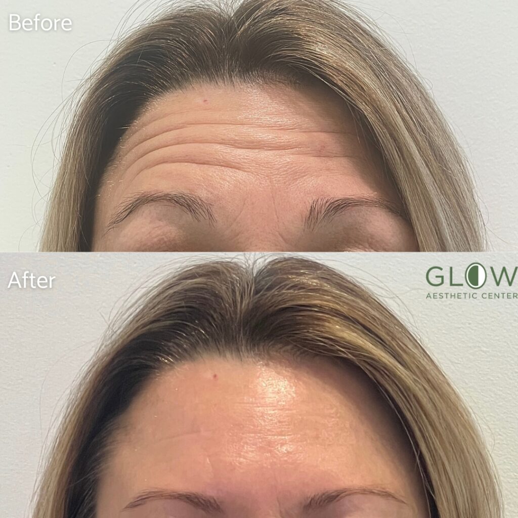 Before and after images showing the reduction of forehead wrinkles and improved skin smoothness, highlighting the results of aesthetic treatments at Glow Aesthetic Center.