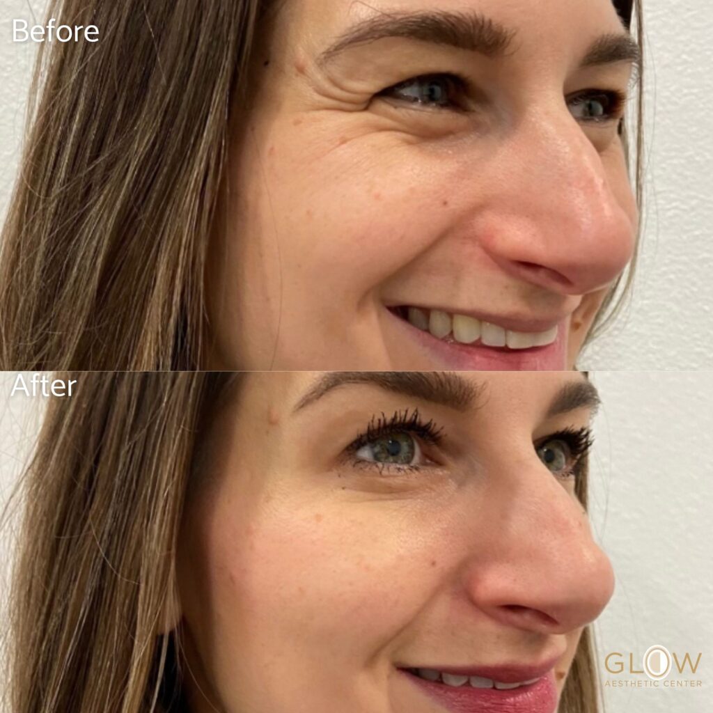 Before and after comparison of a woman's facial appearance, highlighting improvements in skin texture and reduction of wrinkles after a cosmetic treatment at Glow Aesthetic Center.