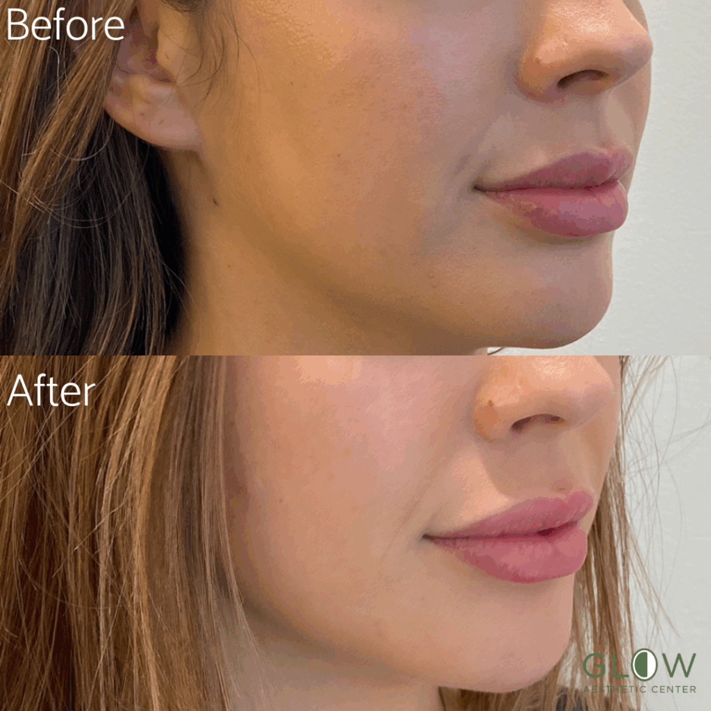 Before and after comparison of lip enhancement treatment showing improved volume and smoothness, highlighting the effectiveness of services at Glow Aesthetic Center.