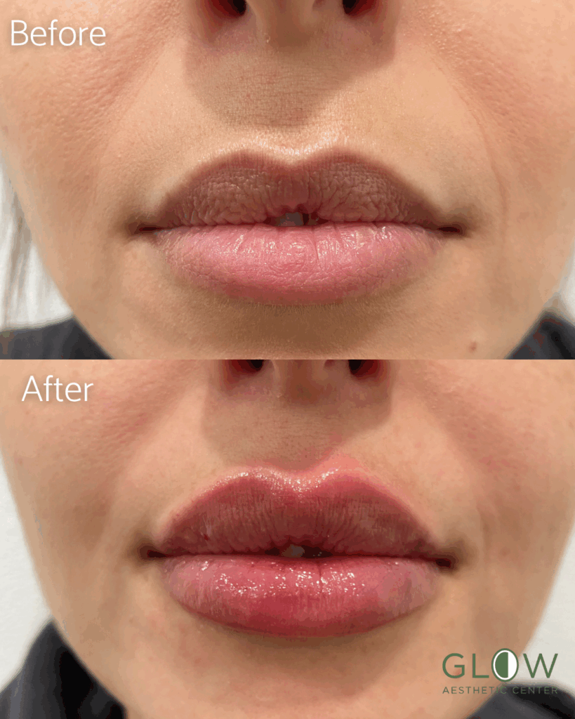 Before and after images showing lip enhancement results at Glow Aesthetic Center, highlighting the transformation from natural, thin lips to fuller, more defined lips with a glossy finish.