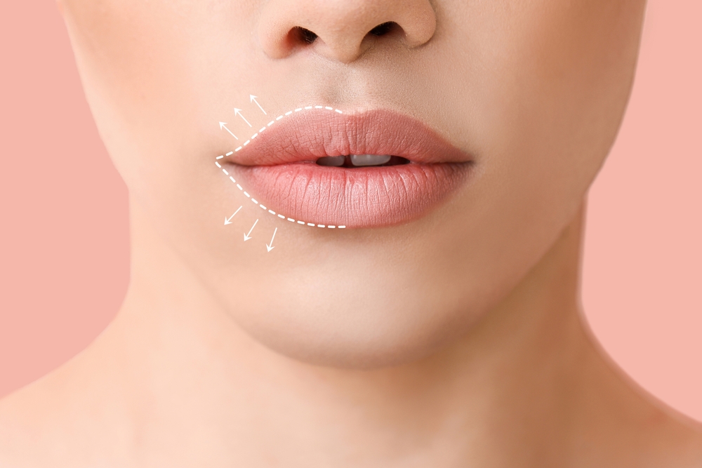 Are Natural Lip Fillers Worth Trying?