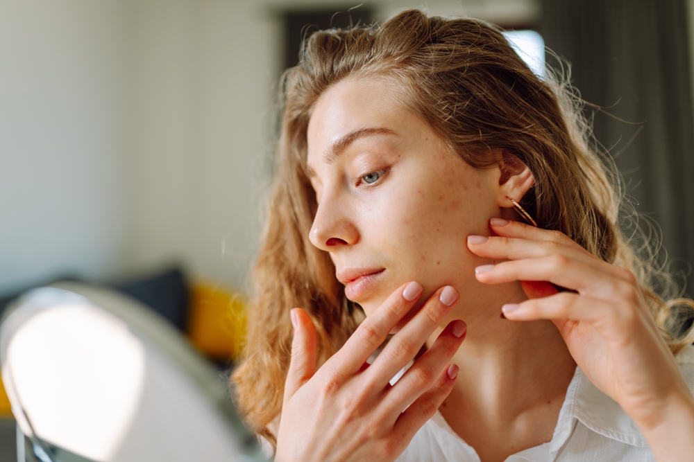 Spearmint Tea for Acne: Overhyped or Worth a Try?